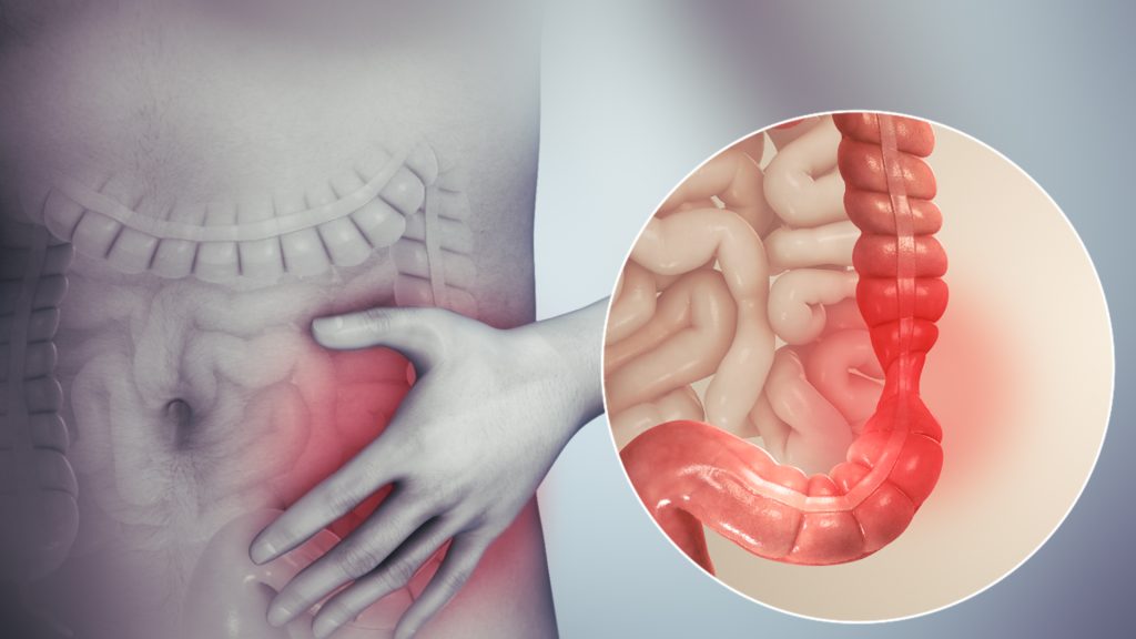 Graphic of irritable bowel syndrome patient