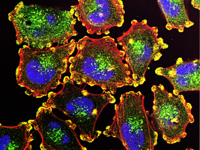 Metastatic melanoma cells, which includes podosomes (yellow), cell nuclei (blue), actin (red), and an actin regulator (green).