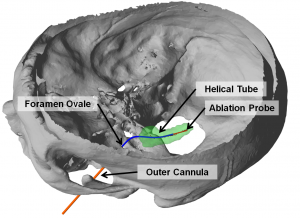 Transforamenal ablation needle concept