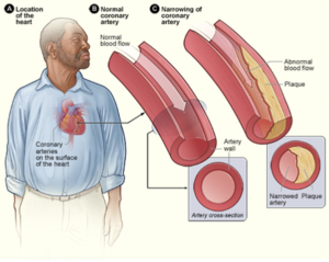 By NIH: National Heart, Lung and Blood Institute - http://www.nhlbi.nih.gov/health/health-topics/topics/cad/, Public Domain, https://commons.wikimedia.org/w/index.php?curid=25287673