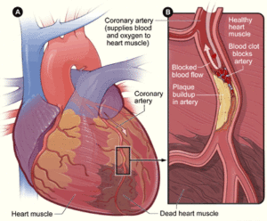 By NIH: National Heart, Lung and Blood Institute - http://www.nhlbi.nih.gov/health/health-topics/topics/heartattack/, Public Domain, https://commons.wikimedia.org/w/index.php?curid=25287085