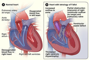 By National Heart Lung and Blood Institute (NIH) - National Heart Lung and Blood Institute (NIH), Public Domain, https://commons.wikimedia.org/w/index.php?curid=29588205
