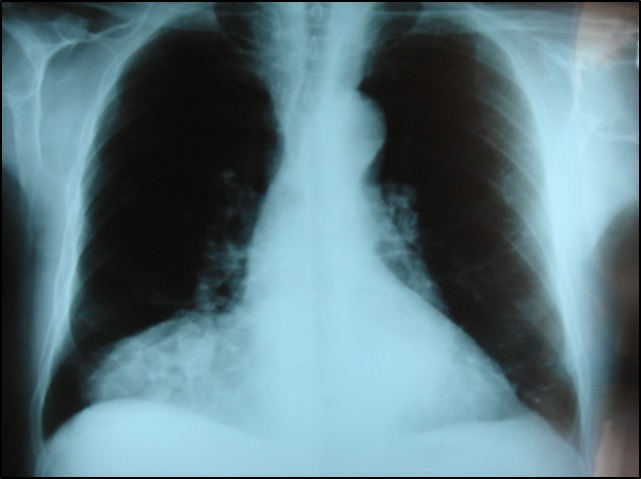 Diaphragmatic Hernia as seen by chest radiograph. (No machine-readable author provided. Joseaperez assumed (based on copyright claims). [CC BY-SA 3.0 (http://creativecommons.org/licenses/by-sa/3.0/)])