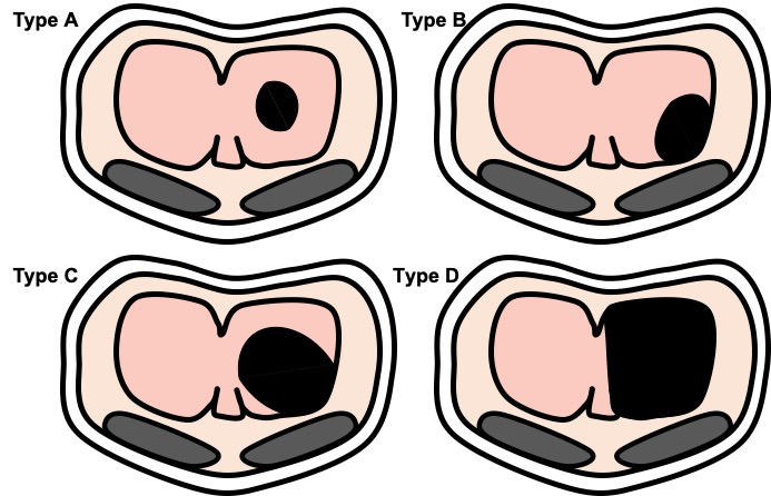 Cartoon depiction of different CDH severity classes. The diaphragm is represented as the center pink region with hernias of varying size.