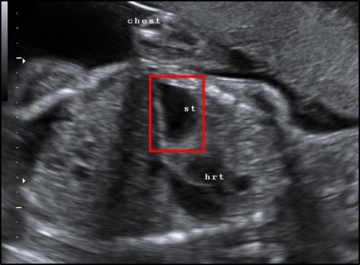 Head, right; feet, left; thorax (chest), center. In this ultrasound of CDH, the stomach and heart can both be seen within the thorax. (Dr Laughlin Dawes [CC BY 3.0 (https://creativecommons.org/licenses/by/3.0)])