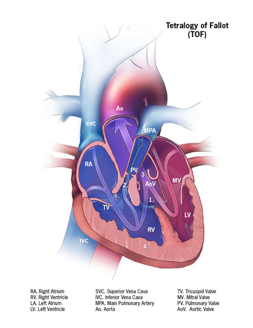 tetralogy of fallot