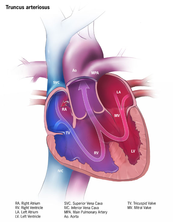 truncus_arteriosus-575px