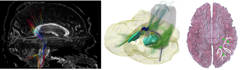 MRI White Matter Reconstruction