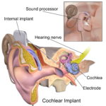 Blausen_0244_CochlearImplant_01