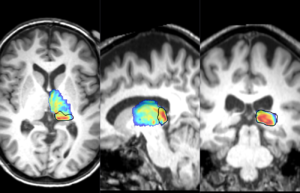 xcon7MNI_heatmap_close5