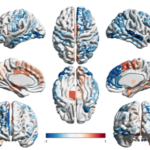 MRI connectivity biomarkers of treatment response in focal epilepsy