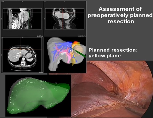 Deformation Corrected Image Guided Laparoscopic Liver Surgery