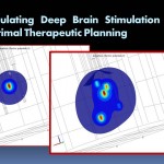 Miga – Simulating Deep Brain Stimulation