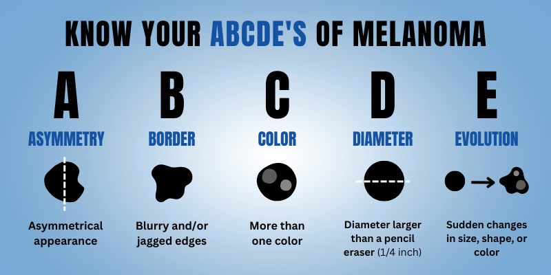 ABCDEs of Melanom