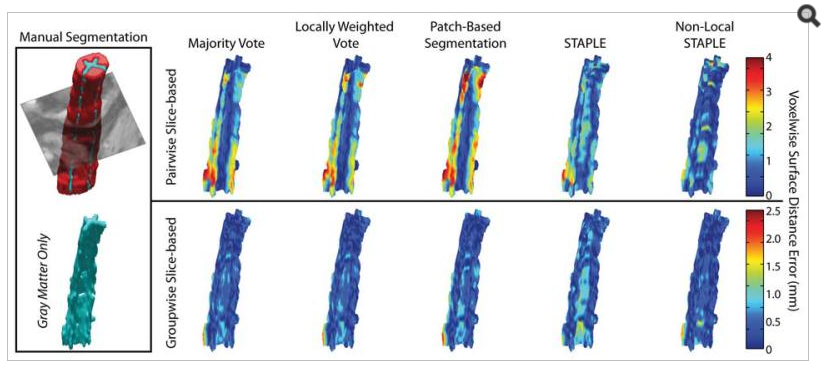 Volumetric qualitative comparison of the accuracy of the segmented gray matter for the pairwise slice-based framework, and the proposed groupwise slice-based framework. The proposed registration framework consistently estimates the complex shape of the GM horn more accurately than its pairwise counterpart. Note the different axes for the two different registration frameworks.