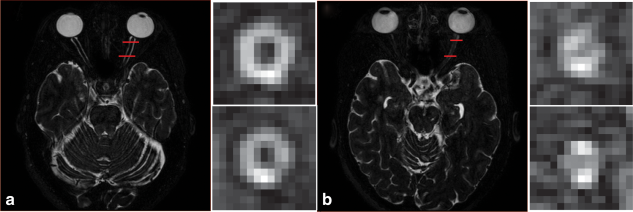 An example of a healthy nerve (A) and an atrophied nerve (B) from the multi-atlas segmentation atlas subjects. In the coronal view, ON atrophy is apparent. Quantification of these structural differences is the target of the presented algorithm.