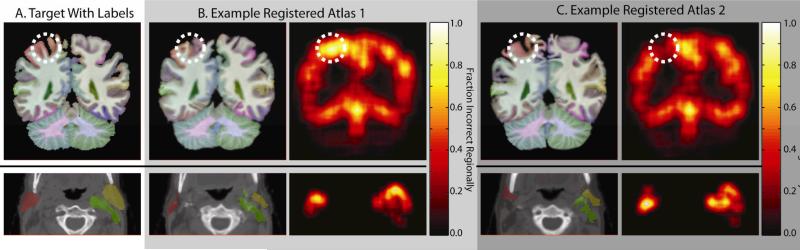 Registered atlases exhibit spatially varying behavior. Representative slices from an expertly labeled MR brain image and CT head and neck image are shown in (A). Example registered atlases with their local performance can be seen in (B) and (C).