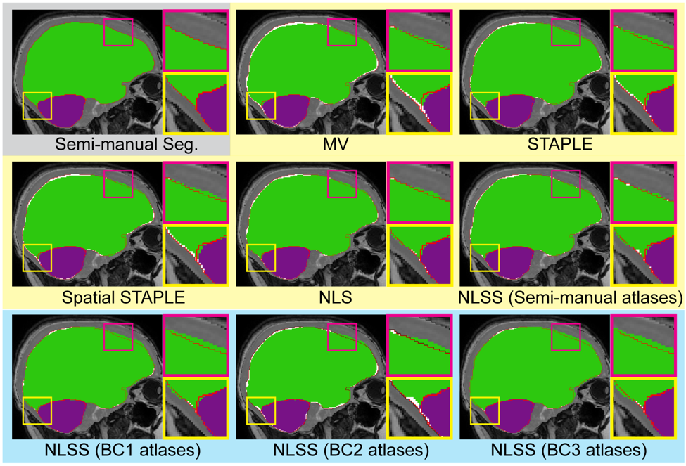 Qualitative results comparing multi-atlas segmentation methods with semi-manual segmentation. The red contours represent the spatial location of the semi-manual segmentation. The white color indicates the negative error, in which the estimated segmentation is smaller than the semi-manual reference. The green and purple color outside the red contours indicates the positive error, in which the estimated segmentation is larger than reference.