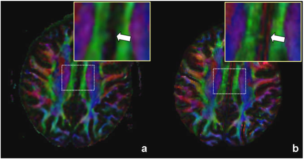 Example potential application of HUBRIS for the reconstruction of improved diffusion tensor imaging (DTI) fractional anisotropy (FA) maps using a multi-shot acquisition. The presented color maps from single-shot (a) and multi-shot (b) echo-planar imaging (EPI) data show multi-shot EPI exhibits reduced blurring and geometric distortions. The generation of the improved images requires a custom reconstruction algorithm that can be accessed by HUBRIS.