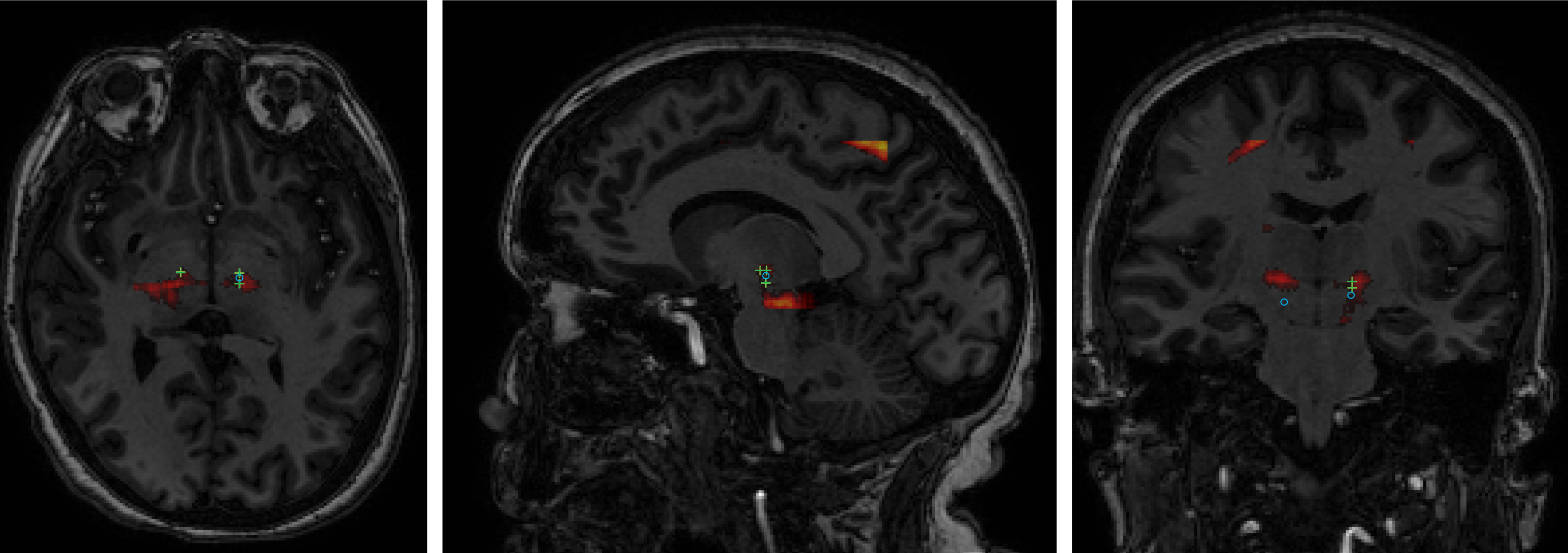 Machine - learning approximat ion of an efficacy map. Patient MRI image overlaid with probability of positive response assessed on a sliding patch basis (assuming an infeasible stimulation at every voxel). Green crosses indicate actual intraope rative stimulation locations with a positi ve response. Blue circles indicate intraoperative stimulation locations with a null response. 