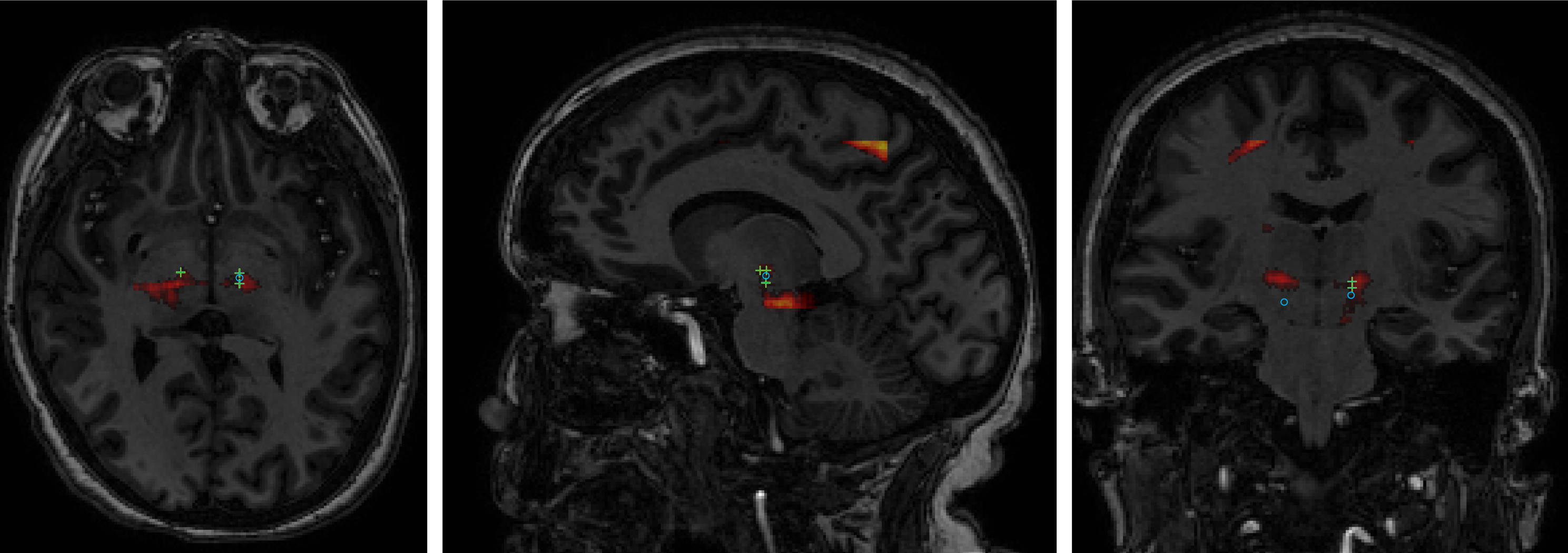 Machine
-
learning approximat
ion of an efficacy map. 
Patient MRI image overlaid with probability of positive response 
assessed  on  a  sliding  patch  basis  (assuming  an  infeasible  stimulation  at  every  voxel).  Green  crosses  indicate  actual  intraope
rative 
stimulation locations with a positi
ve response. Blue circles indicate intraoperative stimulation locations with a null response.