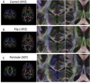 Fig. 1. Effects of incorrect b-vector tables. Diffusion encoded color (DEC) maps and vector maps are shown for a correct gradient table (A), a table with a flipped component (B), and one with permuted components (C). With a flipped component, the DEC map may appear correct, but unit vectors will be flipped in one plane (coronal plane in this example), and will appear correct in another (axial). For a permuted table, both the color maps and vectors will be erroneous. In both (B) and (C), directions are incorrect, and subsequent analysis and tractography will also be erroneous. DEC and vector maps are colored red, green, and blue for diffusion primarily in the right/left, anterior/posterior, and superior/inferior directions, respectively. (For interpretation of the references to color in this figure legend, the reader is referred to the web version of this article.)