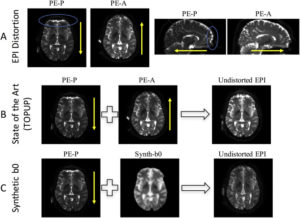Fig. 2. Distortion and correction in diffusion MRI. (A) EPI susceptibility distortion occurs along the phase encode direction, with phase encoding in the posterior (PE-P) direction leading to displacements of identical distance but opposite direction of that in the anterior (PE-A) direction. (B) State of the art distortion correction (topup) typically uses distortions in two opposite directions to iteratively estimate the undistorted image. (C) The proposed method uses an undistorted T1-weighted image to synthesize an undistorted volume with b0 contrast, which can be used to correct the distorted (in this case, PE-P) image without requiring an additional phase encoding acquisition. The blue circles highlight areas of observable signal distortion. Yellow arrows indicate phase encode direction. (For interpretation of the references to colour in this figure legend, the reader is referred to the web version of this article.)