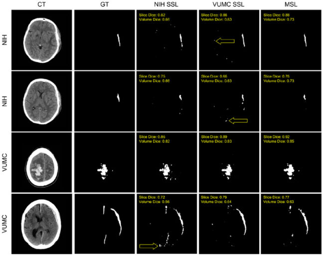 Figure 3 Examples of automatic segmentations are shown. From left to right, the images correspond to the CT, the manual “ground truth” (GT) segmentation, the NIF1 SSL, VUMC SSL, and MSL segmentations. Both the image volume and the specific image slice’s Dice coefficient are overlaid on that segmentation. Yellow arrows specify examples of false positives near the blood-brain barrier which were not present in the MSL segmentations.