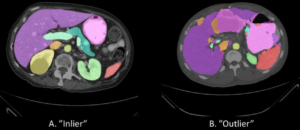 Examples of segmentations generated by the baseline algorithm. A. An inlier, where the algorithm correctly predicted larger organs, like the liver (on the left side of image in purple) and spleen (on the right side of image in red- pink) and suggested mostly accurate areas of smaller organs. B. An outlier (global failure), where the liver (purple) and spleen (red-pink) were largely correct but major inconsistencies are visible with other organs.