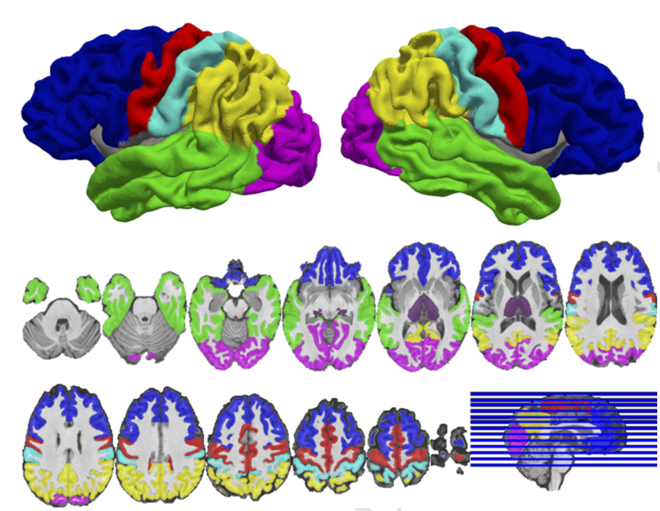 Cortical regions‐of‐interest (ROIs) and thalamus for one subject. Segmentations derived from multi atlas were used to create subject‐specific ROIs for the thalamus (purple) and 6 cortical subdivisions: prefrontal cortex (blue), motor cortex/supplementary motor area (red), somatosensory cortex (cyan), temporal cortex (green), posterior parietal cortex (yellow), and occipital cortex (violet). The thalamus and cortical ROIs were used as seed and targets, respectively, to quantify thalamocortical structural connectivity using probabilistic tractography. The lateral surface renderings in the top panel were generated by projecting the cortical ROIs onto the central surface of the cortical mantle.