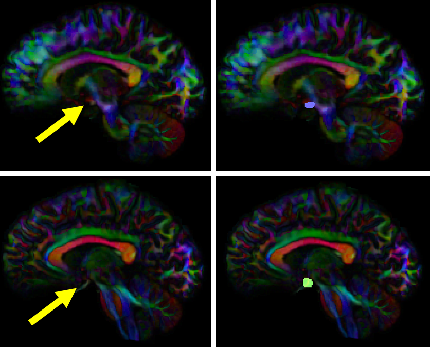 Optic Tract Opt Whole Brain Protocol For Tractography With Empirical Mri