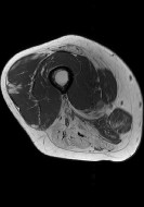 Myositis