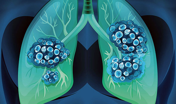 small-cell-lung-cancer-vanderbilt-university