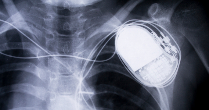 xray of pacemaker