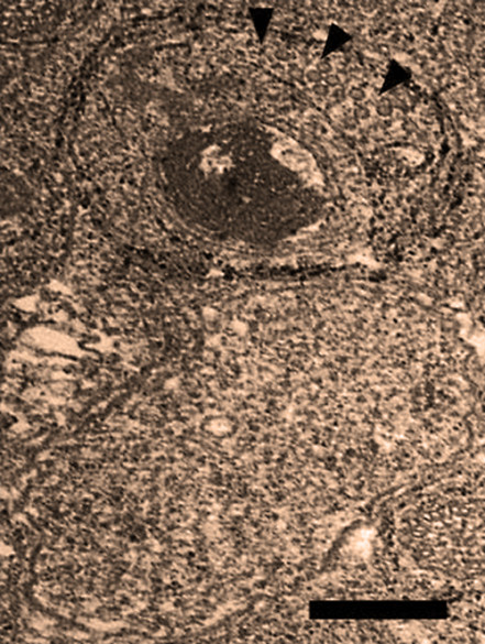 Electron microphotograph shows two Wolbachia cells that have infected a Nasonia wasp. The top one is infected with the WO phage, pointed out by the black arrowheads. The bottom one is uninfected. The large dark patch is bacteria DNA that has been degraded by the phage. The image also shows the multiple wasp membranes wrapped around the Wolbachia that the phage must penetrate both to enter and escape from the bacteria. (Bordenstein Lab / Vanderbilt)
