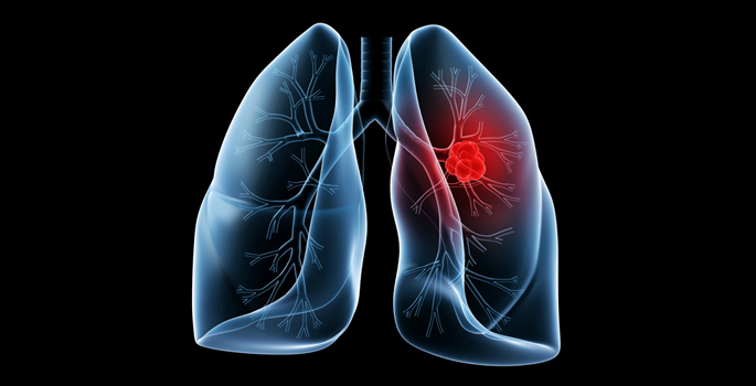 x-ray of lungs with a suspicious spot highlighted in red