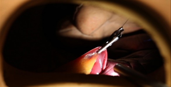 Surgical image of the retractor in vivo