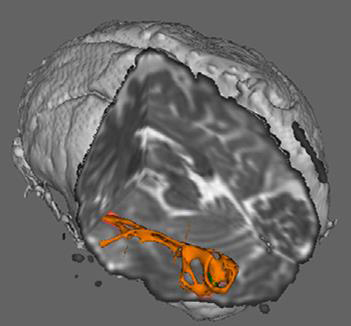 Fiber pathways in the brain. (Vanderbilt)