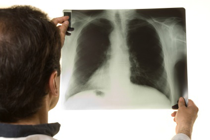 xray of lung