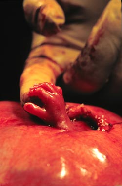 During surgery on a 22-week-old fetus at Vanderbilt, Dr. Joseph Bruner demonstrates size by comparing the fetus’ hand to his index fingertip. (1999 file photo by Anne Rayner/Vanderbilt)