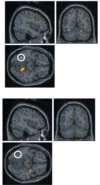 In a paper by McCandliss and several other scientists published in Developmental Science in 2006, functional magnetic resonance imaging (fMRI) scans on this and the previous page were used to  illustrate that among children of equivalent phonological skill, yet diverse socioeconomic backgrounds, a child’s experience affects the relationship between language skills and reading-related brain activity.    