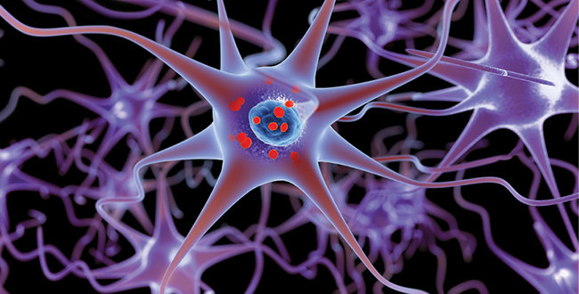 Parkinson’s disease is illustrated in this 3D image showing accumulation of protein deposits, as represented by small red spheres, in brain cells. (Lars Neumann/istock)