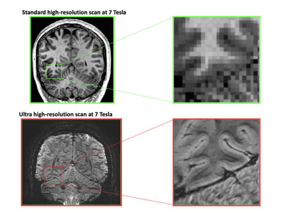 klem Kritiek voor de helft Advanced, high-res MRI scans reveal link between cognitive abilities and  'tree ring' layers in the brain | Vanderbilt University