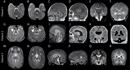 EXOC2 related neurological disorder