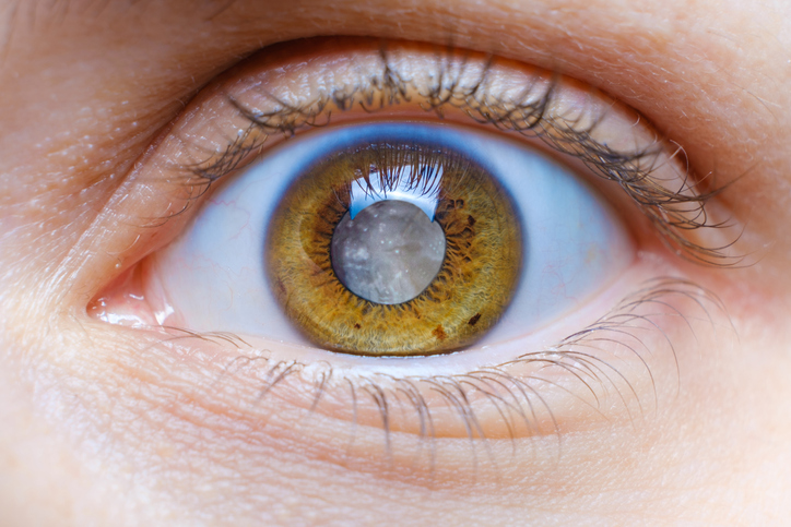 Measurements of age-related changes in eye lens proteins yield insights into cataract formation