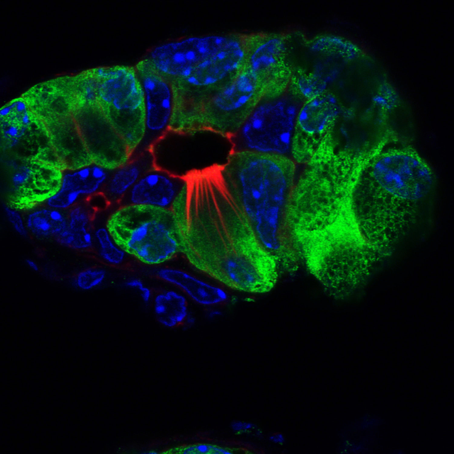 Pancreatitis is a major risk factor for pancreatic cancer. We have identified formation of these rare cell populations in the injured pancreas and are currently investigating their role in injury, healing, and pancreatic regeneration (Red, Actin; Green, YFP).