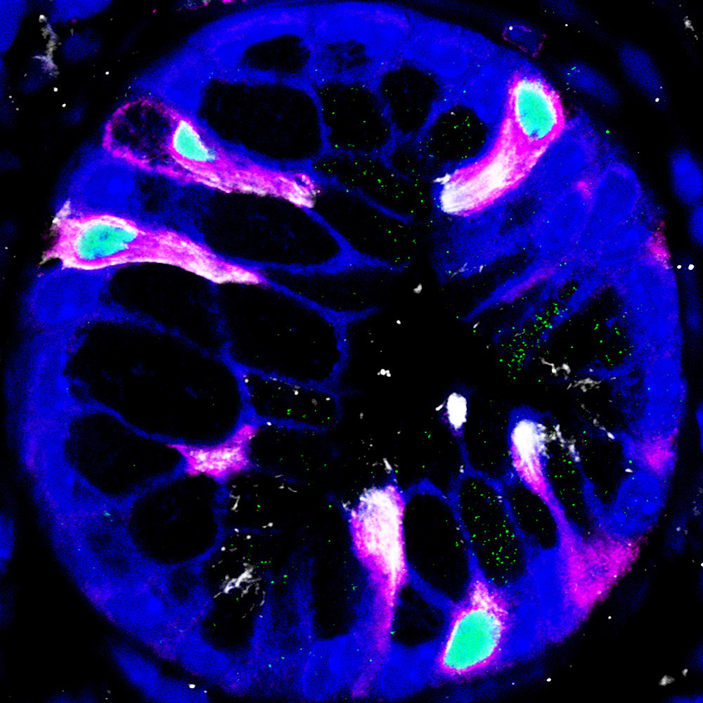 We have found that oncogenic mutation in the pancreas leads to genesis of a number of different secretory cell types, including tuft cells (Pink, COX1; Green, POU2F3; White, ac-a-tubulin; Blue, nuclei).