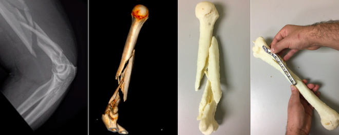 3D printed arm bones could aid in surgery planning, surgeon training | School of Engineering | Vanderbilt University