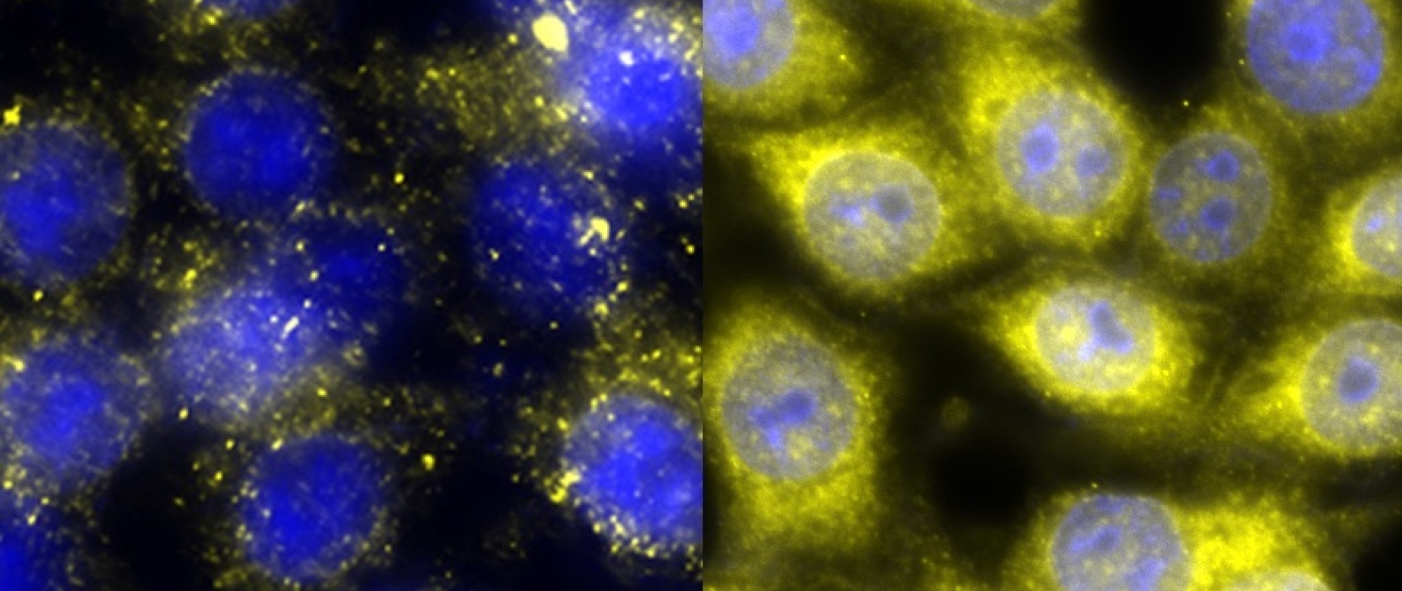 APC is a tumor suppressor that negatively regulates the Wnt pathway. RKO cells with wild-type (left) and knocked out APC (right). These cells have been stained for beta-catenin (yellow) and DNA (blue) Note the intense staining of beta-catenin upon loss of APC.