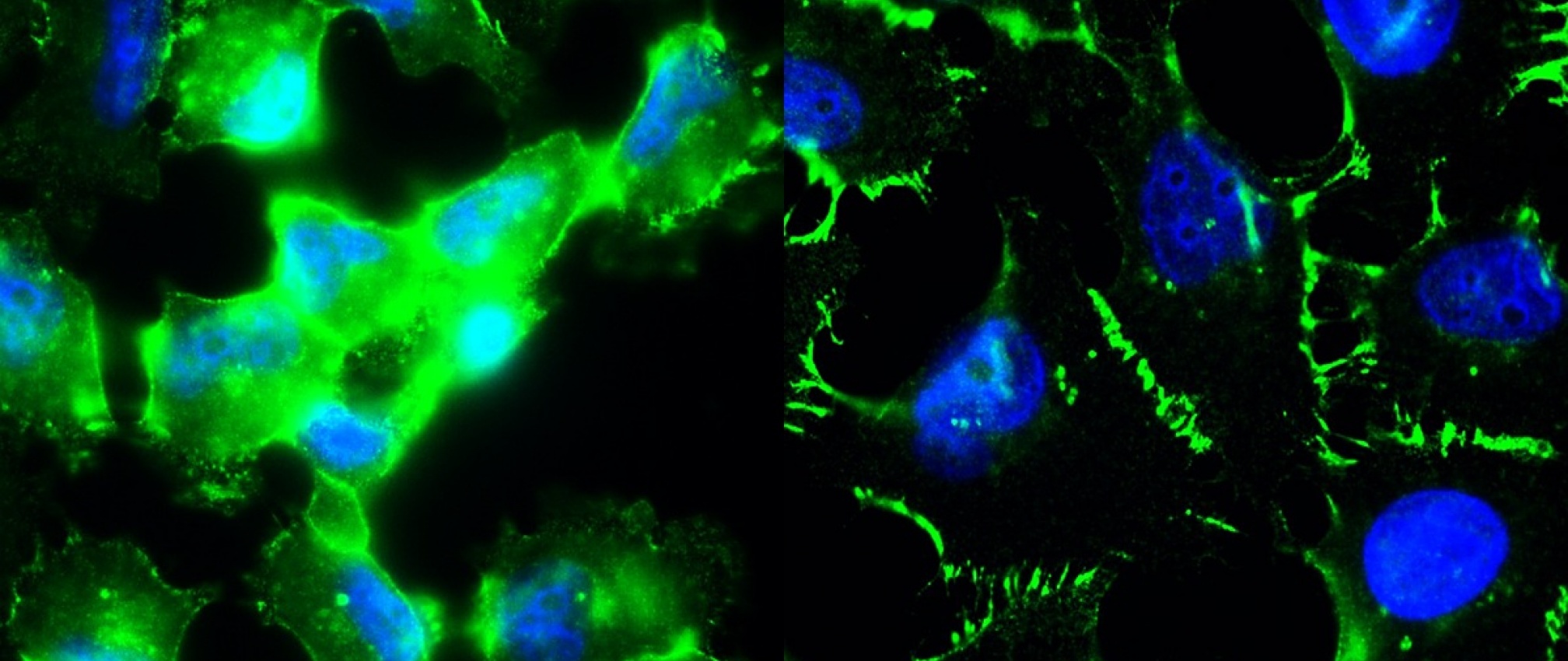 The triple negative breast cancer line, MDA-MD-231, exhibit high levels of beta-catenin staining (left) and elevated Wnt signaling. Incubating MDA-MD-231 cells with an antibody that binds the Wnt coreceptor, LRP6, dramatically decreases cytoplasmic beta-catenin staining and promotes beta-catenin localization to the cell junctions (right). Green is beta-catenin and blue is DNA.